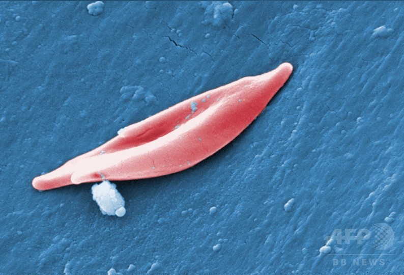 鎌状赤血球症、遺伝子治療で症状緩和に初成功 研究 鎌状赤血球症、遺伝子治療で症状緩和に初成功 研究