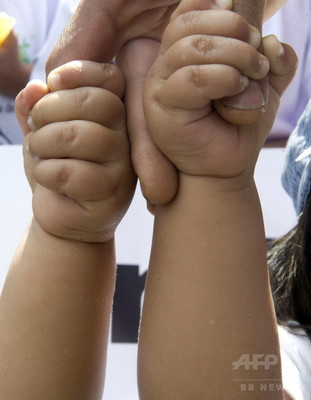 双子のがんリスク、片方発病で上昇 大規模調査 双子のがんリスク、片方発病で上昇 大規模調査