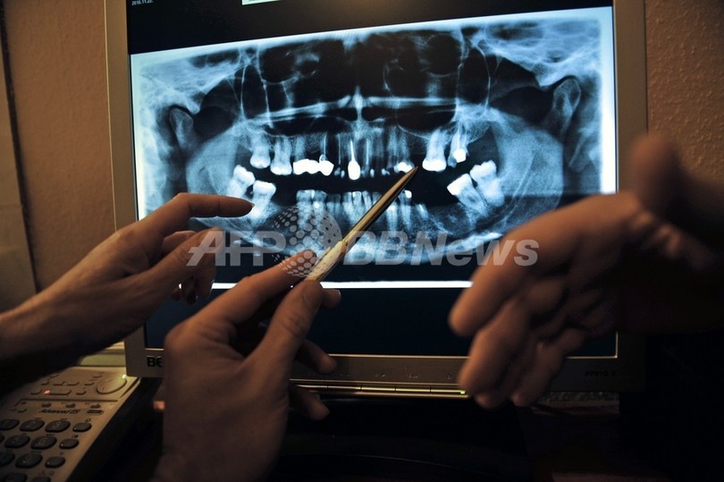 歯科X線検査、脳腫瘍と関連性 米研究 歯科X線検査、脳腫瘍と関連性 米研究