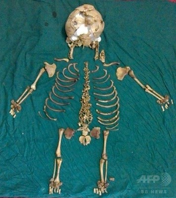 母親の体内に36年間、胎児の骨格を摘出 インド 母親の体内に36年間、胎児の骨格を摘出 インド