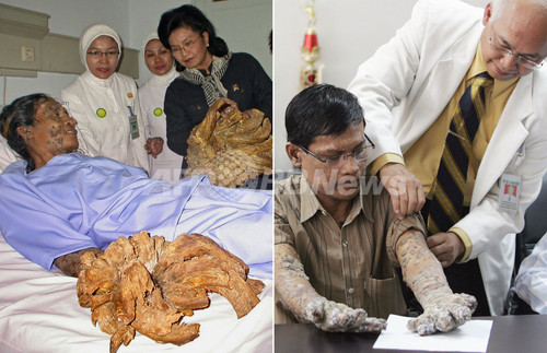 インドネシアの「樹木男」、手足から重さ6キロのイボ除去に成功 インドネシアの「樹木男」、手足から重さ6キロのイボ除去に成功