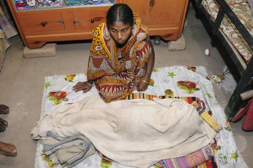 水頭症を患った5歳女児、息苦しさ訴え突然死 インド 水頭症を患った5歳女児、息苦しさ訴え突然死 インド