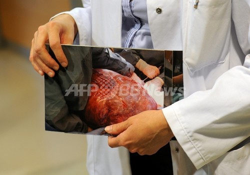 肥満と誤診の女性から28キロの腫瘍摘出 肥満と誤診の女性から28キロの腫瘍摘出