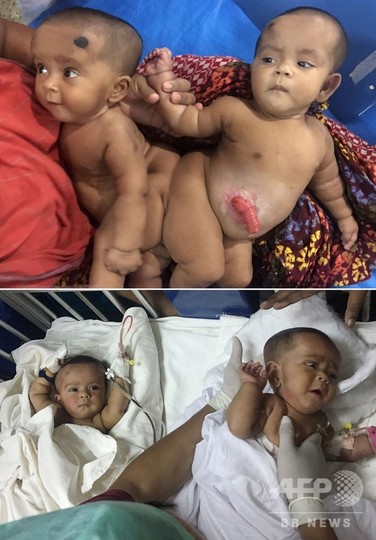 バングラデシュの結合双生児、分離手術から1年半後に無事退院 バングラデシュの結合双生児、分離手術から1年半後に無事退院