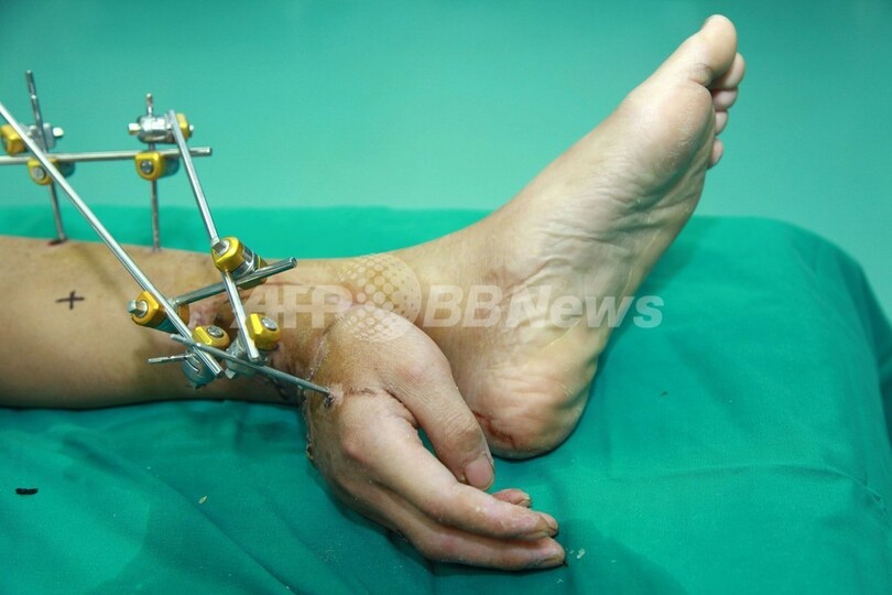 切断された手を足に接続して保存 1か月後に再接合 中国 写真5枚 国際ニュース Afpbb News