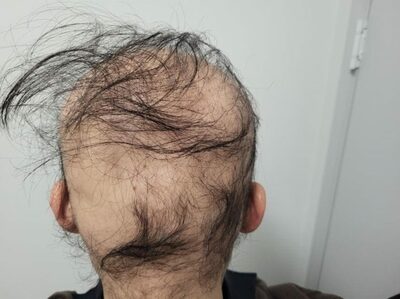 「急に髪の毛が全部抜けた」という韓国の男性、何が起きた？