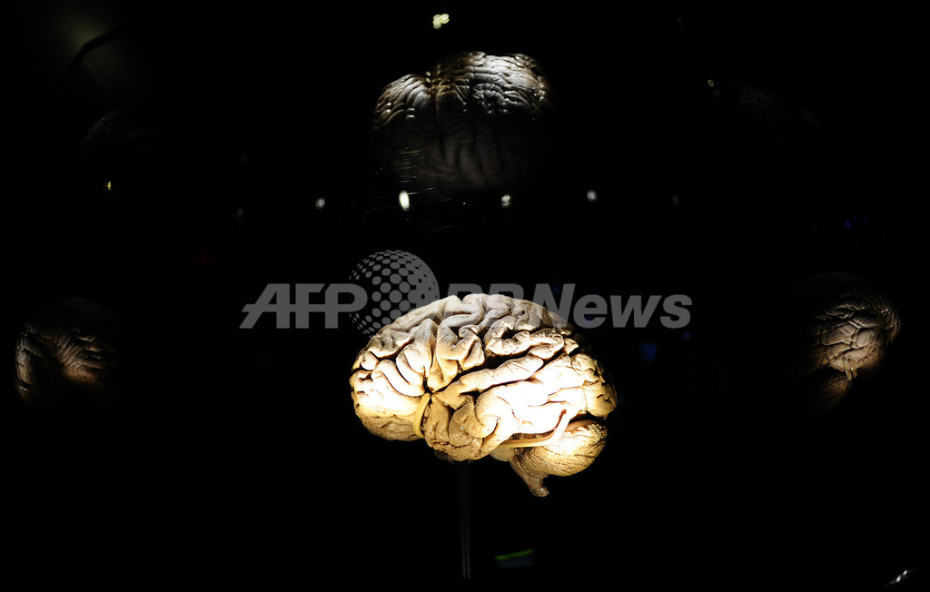 片頭痛、恒久的な脳構造の変化もたらす可能性 研究 片頭痛、恒久的な脳構造の変化もたらす可能性 研究
