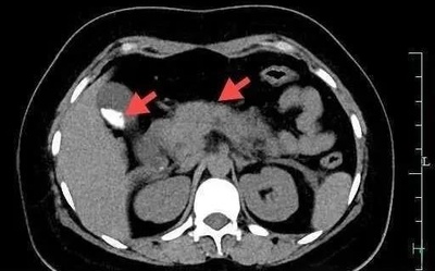 カニを一気に4杯食べた女性 急性膵炎で夜中に救急治療