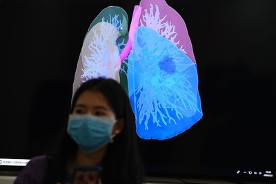 世界初、新型ウイルス患者の肺移植手術に成功 中国・無錫