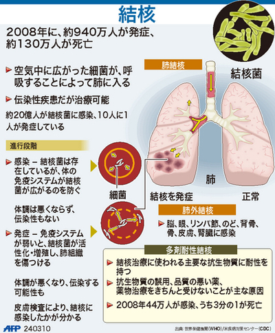 【図解】結核