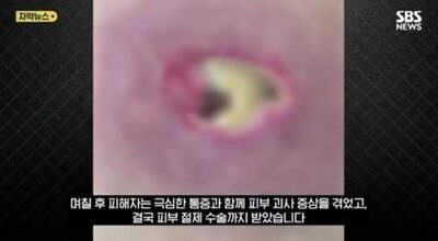 「親切心」で皮膚が壊死…韓国・寝ている間に“勝手に”ほくろを取られた女性