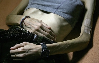 拒食症の女性をモデルにスカウト、スウェーデンで批判の声