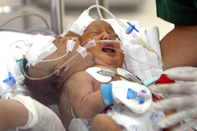 分離手術は困難、インドネシアの結合双生児