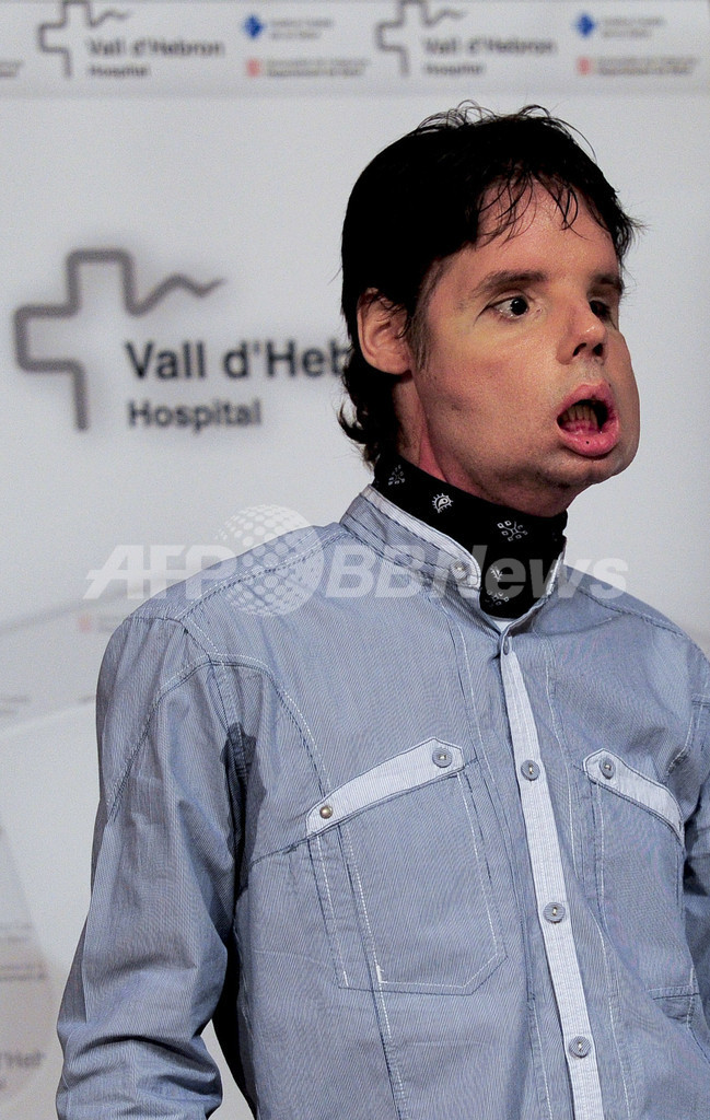 世界初の顔面完全移植男性、TV記者会見で感謝の言葉 スペイン