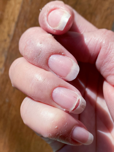 中国 12歳の女の子が1日にコーヒー3杯で中等度貧血に