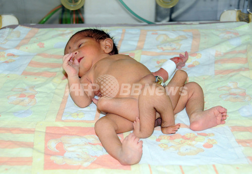 パキスタンで脚が6本ある赤ちゃん生まれる 写真3枚 ファッション ニュースならmode Press Powered By Afpbb News