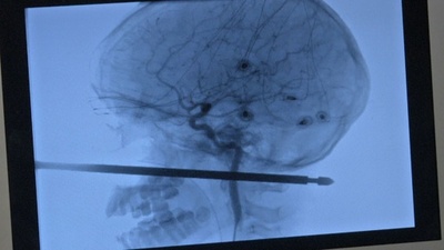 ツリーハウスから転落し金串が頭部ほぼ貫通、脳に損傷なし 米10歳児