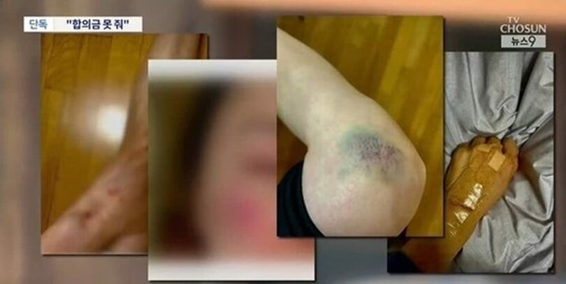 突然倒れたガラス窓により負傷した女性の傷跡＝TV朝鮮キャプチャー(c)news1