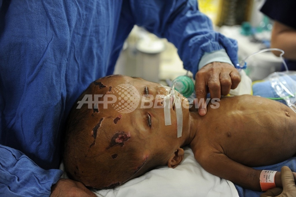 インド水頭症女児、頭蓋骨再建手術の第1段階成功 インド水頭症女児、頭蓋骨再建手術の第1段階成功