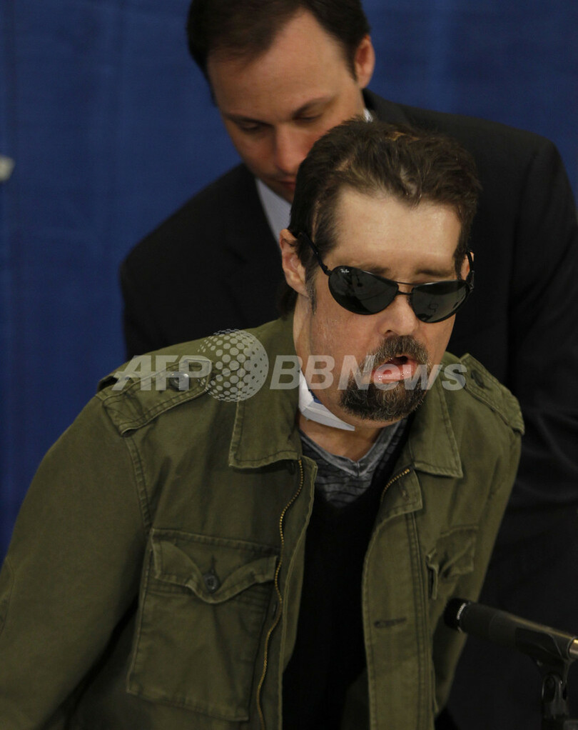 米国初の全顔面移植の男性、新しい顔で会見