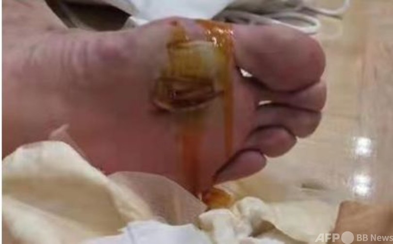 バド単「銀」の諶龍、ひどい足のけが抱えながら決勝を戦う