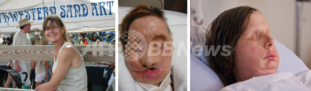 チンパンジーに襲われて顔面を失った米女性 移植後の写真公開 写真2枚 国際ニュース Afpbb News