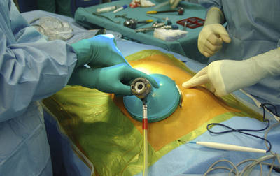 ロボットを使ったすい臓移植手術に成功、合併症もなし イタリア