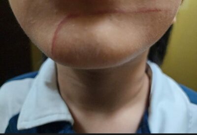 韓国・小1の担任「息子さん、ちょっと引っかかれた程度の傷」…実は絆創膏の下に「衝撃の傷口」