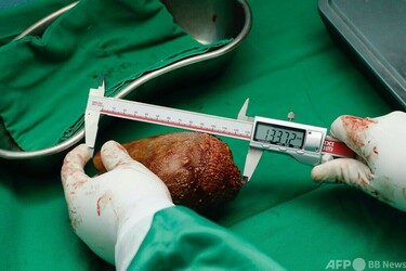世界最大の腎臓結石」を摘出 スリランカ 写真1枚 国際ニュース：AFPBB News