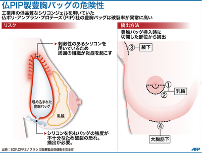 仏PIP社の豊胸バッグ問題、元社長を逮捕