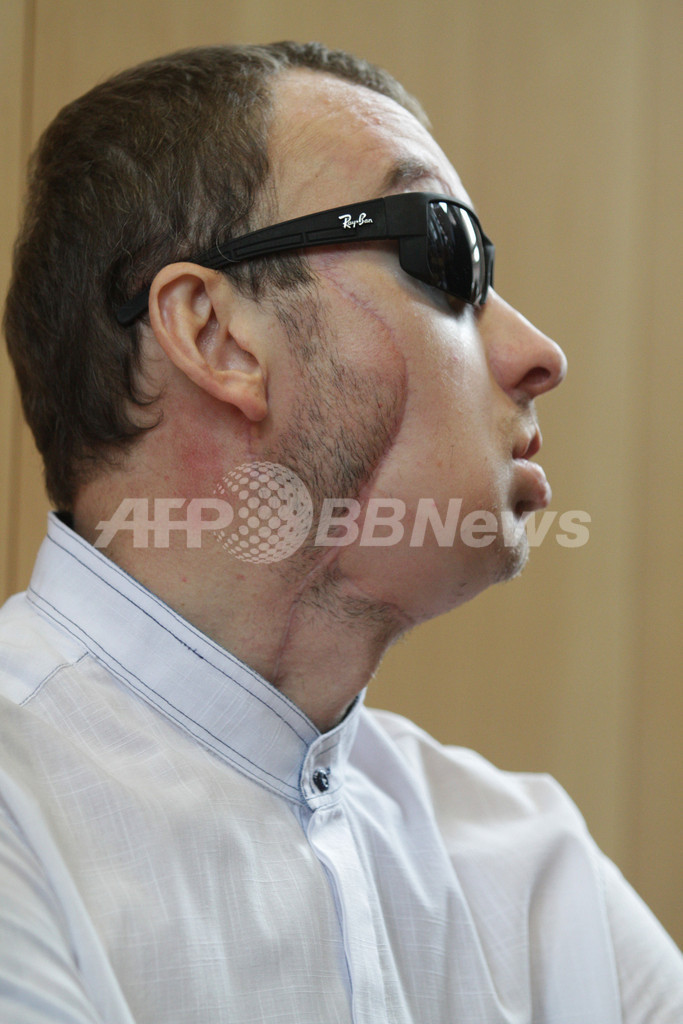 「世界初の救命顔面移植」受けた男性が会見、退院へ ポーランド