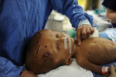 インド水頭症女児、頭蓋骨再建手術の第1段階成功