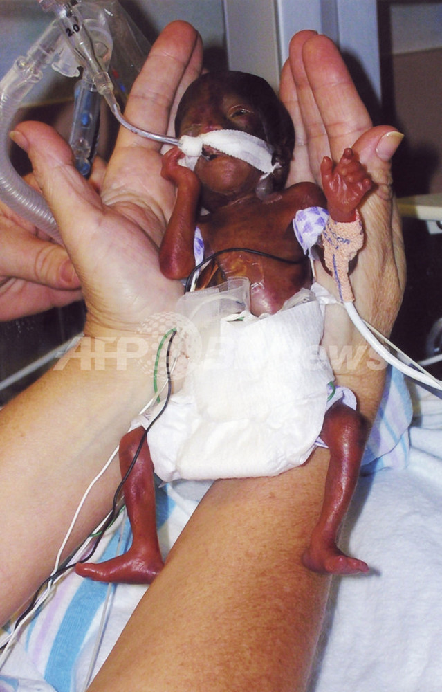 身長10インチ未満の世界最小の超未熟児 順調に成育 米国 写真3枚 国際ニュース Afpbb News