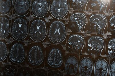 韓国の研究チーム、脳卒中の治療時間を48時間に拡大…画期的な新薬候補物質を開発