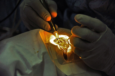 白内障に「点眼薬」、手術なしの治療に期待 研究