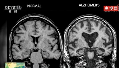 中国人科学者がアルツハイマー病分野で 記憶衰退を引き起こす「引き金」見つけ出す