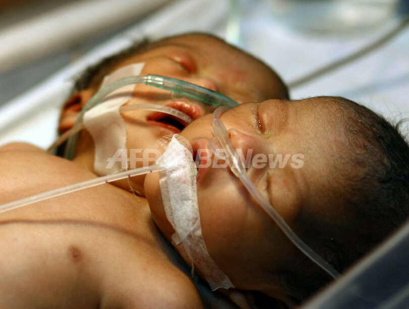フィリピンで結合双生児が誕生、生存の鍵は主要臓器の数
