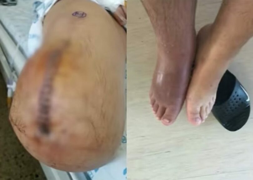 労働災害で片足を失った溶接工・チョン・ナラスさん＝YouTubeチャンネル「kizzle」(c)MONEYTODAY