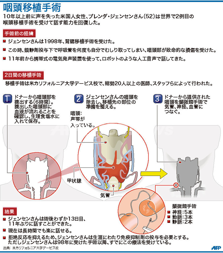 世界2例目の咽頭移植手術で発声能力回復 米女性 写真1枚 国際ニュース Afpbb News