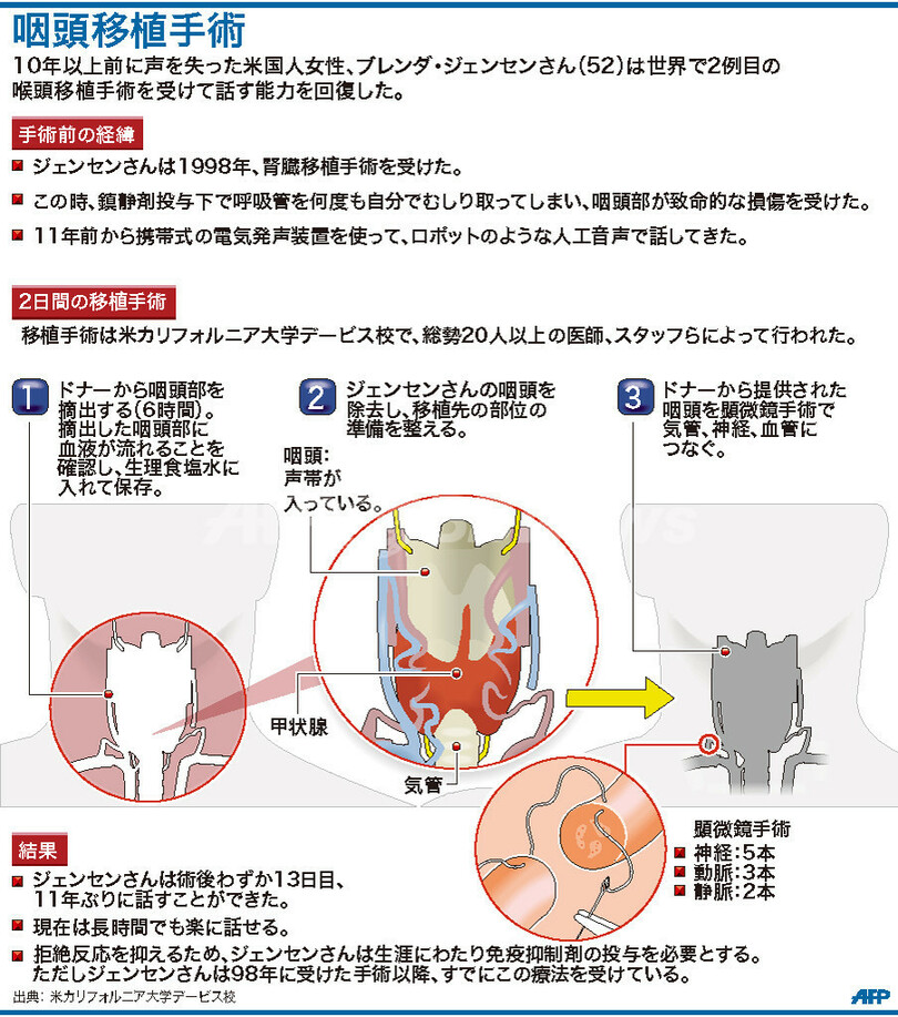 世界2例目の咽頭移植手術で発声能力回復、米女性