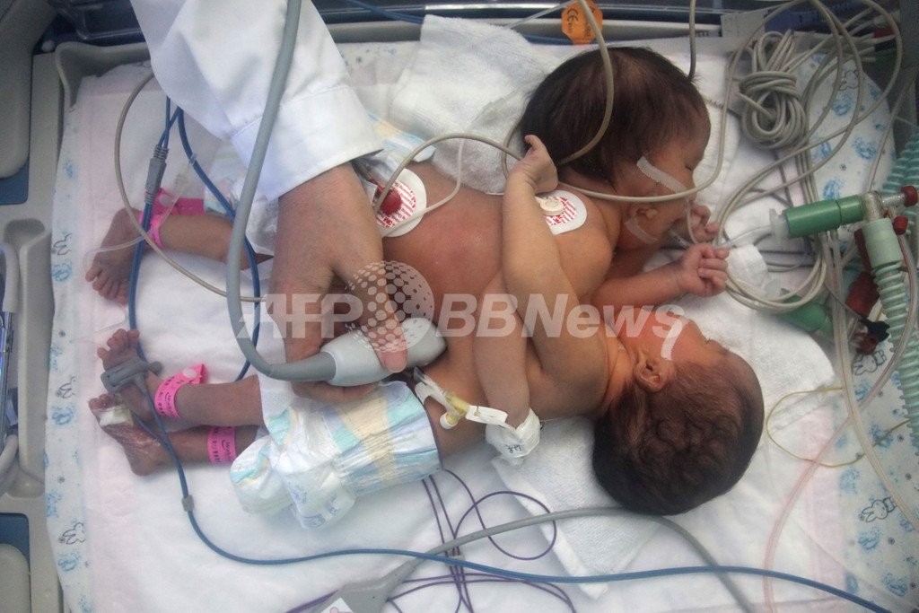 北京で女児の結合双生児が誕生、分離手術へ 写真8枚 国際ニュース:AFPBB News
