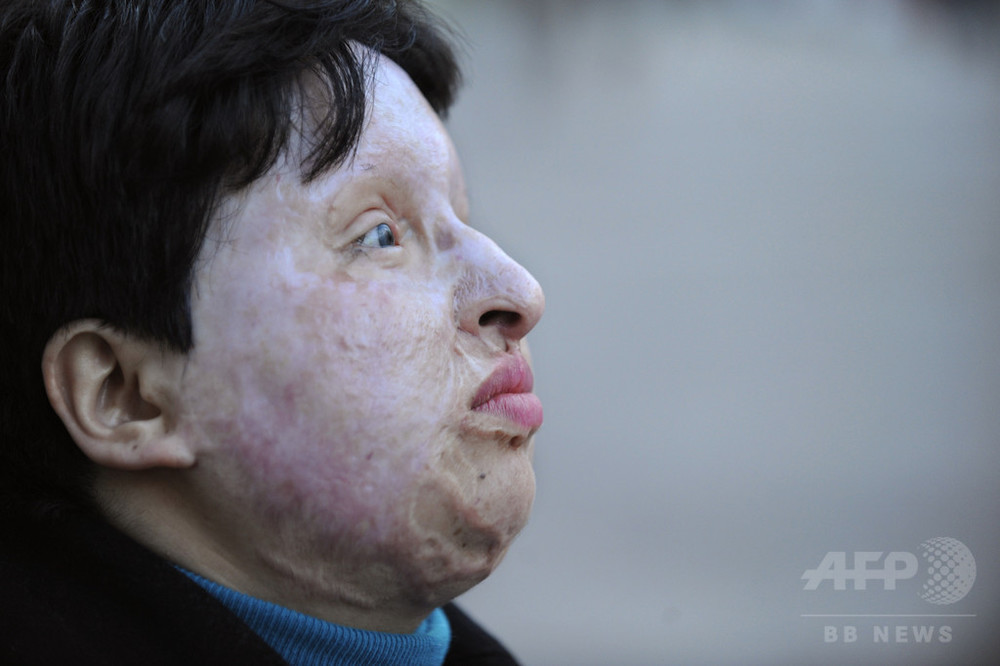 イラン 目には目を で男に失明刑執行 4歳児の視力奪った罪で 写真3枚 国際ニュース Afpbb News