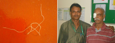 目から長さ13センチの寄生虫、インド