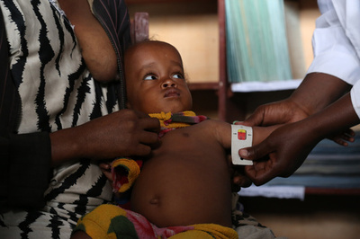 アフリカ、重度栄養失調の子ども100万人 ユニセフ