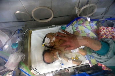 イエメンで結合双生児誕生、サウジ医療班が受け入れを申し出