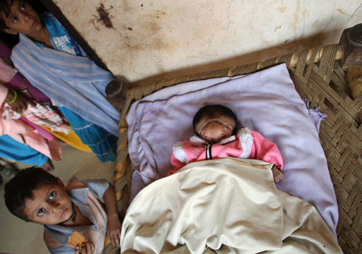 インドで顔が2つある赤ちゃん誕生 神の化身 写真4枚 国際ニュース Afpbb News