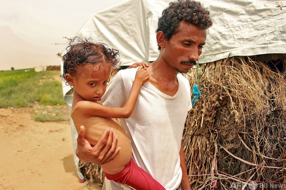 イエメン、幼児の栄養失調が深刻化 コロナや資金不足で 国連報告
