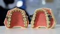 新開発された減量器具「デンタルスリム・ダイエット・コントロール」。ニュージーランドのオタゴ大学提供（撮影日不明、2021年6月29日入手）。(c)AFP PHOTO / UNIVERSITY OF OTAGO