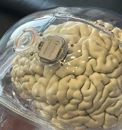 中国 128チャンネル完全埋め込み式のBMI臨床試験が開始 