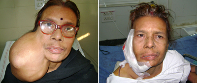 サッカーボール大の腫瘍、女性の顔から摘出成功 インド